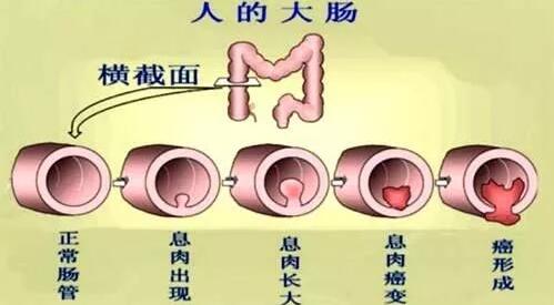 为什么肠癌一发现就是晚期？难道身体没有提前发出预警信号吗？