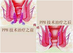 福州肛肠医院