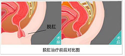 脱肛的手术费用怎么样？