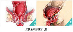 福州肛肠医院