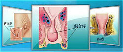 了解痔疮病因，重视痔疮防治！