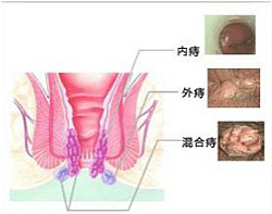 治疗痔疮为什么选福州医博？