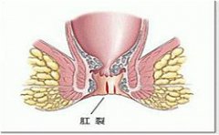 患者现身说法，带你了解肛裂危害