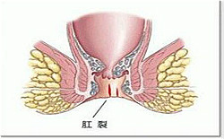 女性肛裂是什么原因引起的？怎么治疗好？