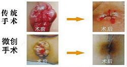 福州医博痔疮创口微小方法有哪些优点？