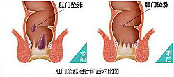 科普向：肛门坠胀的预防和检查