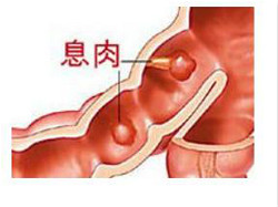 肛门肉球一定是痔疮