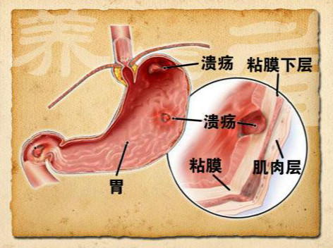 导致胃溃疡的病因都有哪些？