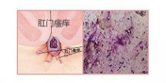 肛门瘙痒病因分析及预防