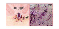 肛门瘙痒病因分析及预防建议