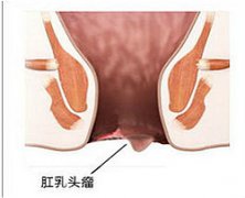 肛乳头肥大的危害你了解