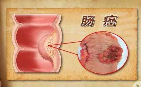 肠道出血原因何在？有些疾病不可大意！