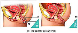 比瘙痒更复杂！肛门湿疹是怎么回事？