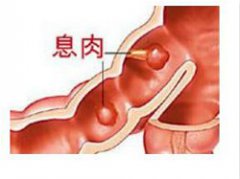 肠道息肉是只有一个,还