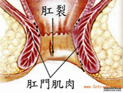 女性肛裂为什么发病率那么高？