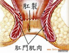 肛裂初发不可手术,保守