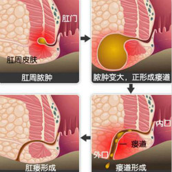 肛瘘症状的治疗方法有哪些