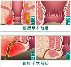 肛瘘症状的治疗方法有哪些