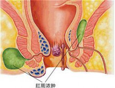 肛周脓肿的分类及其症状