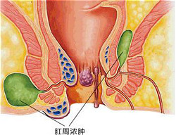 肛周脓肿的分类及其症状介绍