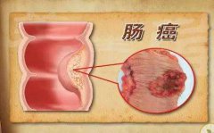 直肠癌晚期症状是什么?