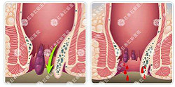 痔疮流血需趁早治疗，术后调理不可或缺！