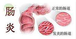 直肠炎并不单纯，并发症和自身症状都需了解！