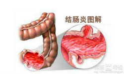 病因和症状分析：认识结肠炎，及早治疗