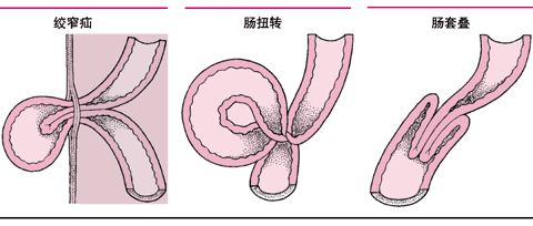 小儿肠套叠的症状，早发现早治疗！