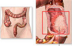 慢性肠炎会引起肠道恶变，不可大意！