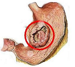  胃癌有什么预防措施吗？