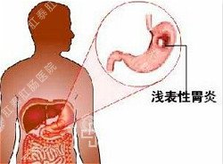 慢性胃炎有什么危害？