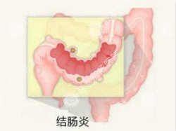 结肠炎有哪些症状？