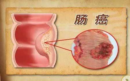 直肠癌的症状和前兆及其预防工作？