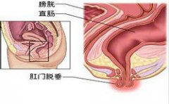 脱肛的症状有哪些表现