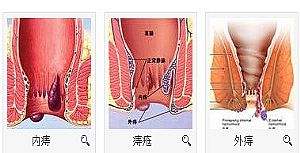 混合痔嵌顿坏死症状有哪些