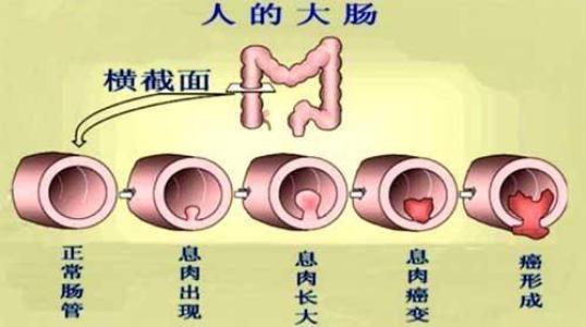 老年人怎么预防肠道疾病