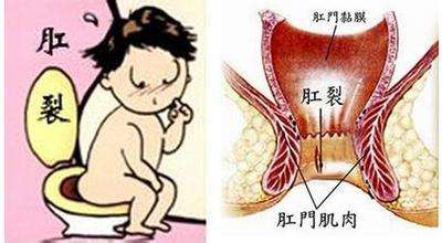 福州治疗肛裂大概要多少钱