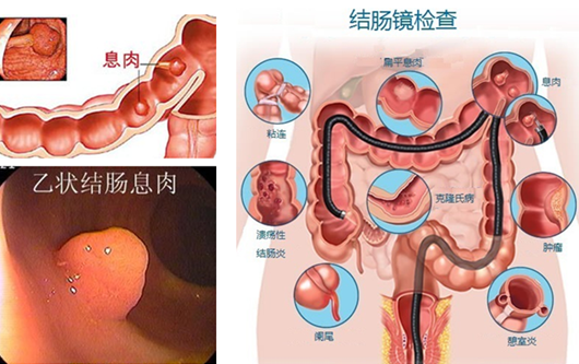 福州哪家医院专治肛瘘