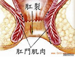 福州治疗肛裂要花多少钱