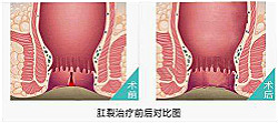 福州治疗肛裂要花多少钱