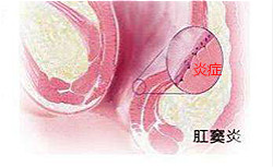 肛窦炎的治疗办法和预防建议