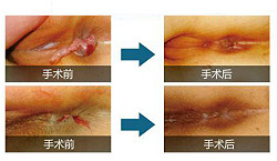 肛瘘的治疗办法和预防建议