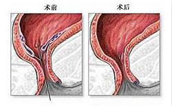 福州痔疮创口微小手术有什么优势