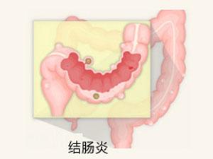 福州治疗结肠炎哪个医院好