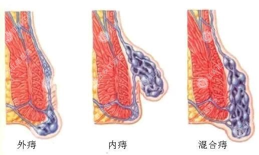 痔疮长什么样,痔疮图片