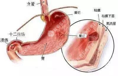 胃健康必备常识：“福州老胃病”到底能不能拖？