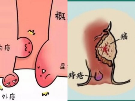 福州市哪个医院治痔疮专业