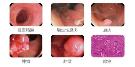 胃病5年,吃药5年,为什么胃病没好反而加重了？