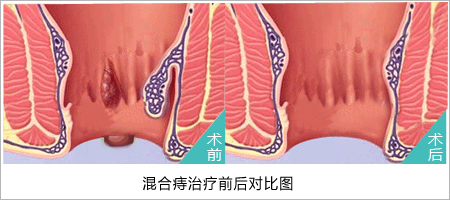 福州肛肠医院 福州医博肛肠医院 福州看痔疮的医院 福州肛瘘医院 福州肛裂医院 福州肠炎医院